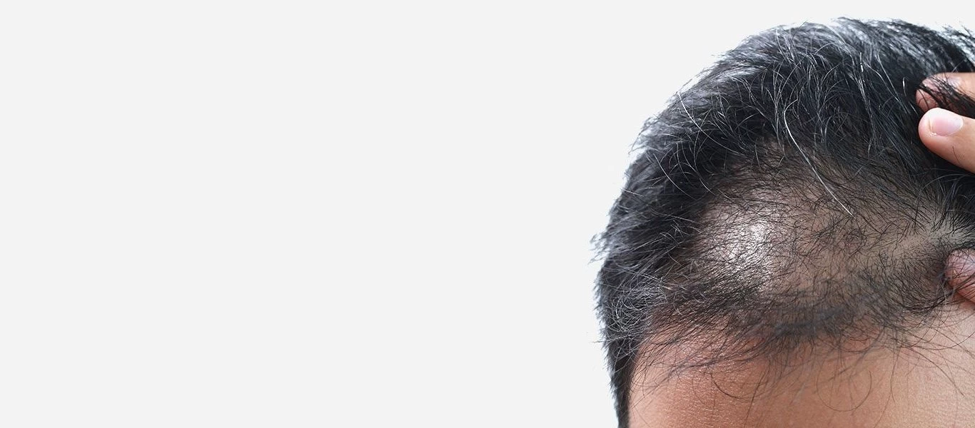 Αλωπεκία: Τι την προκαλεί - Πως να την αντιμετωπίσετε